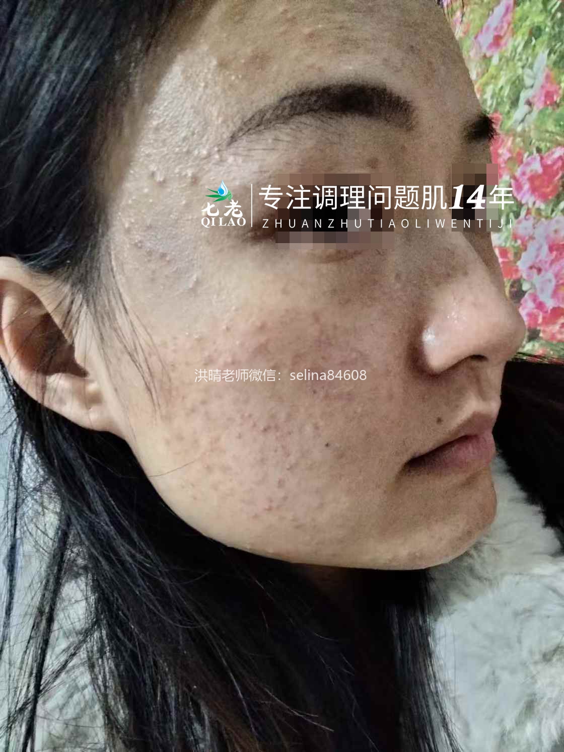 七老激素脸顽固痘痘修复案例