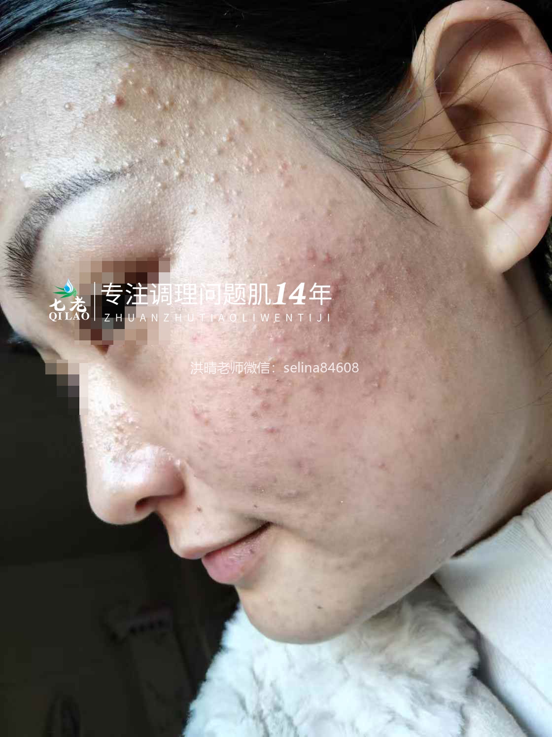 七老激素脸顽固痘痘修复案例