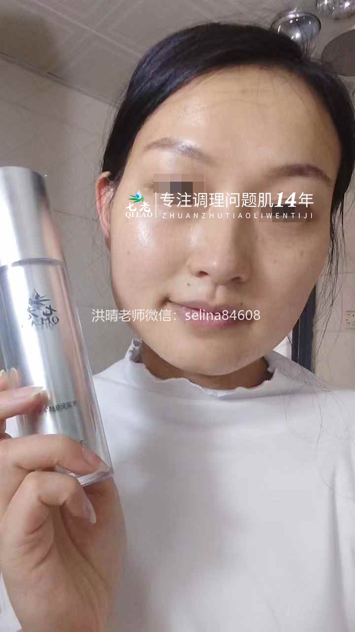 七老激素脸顽固痘痘修复案例