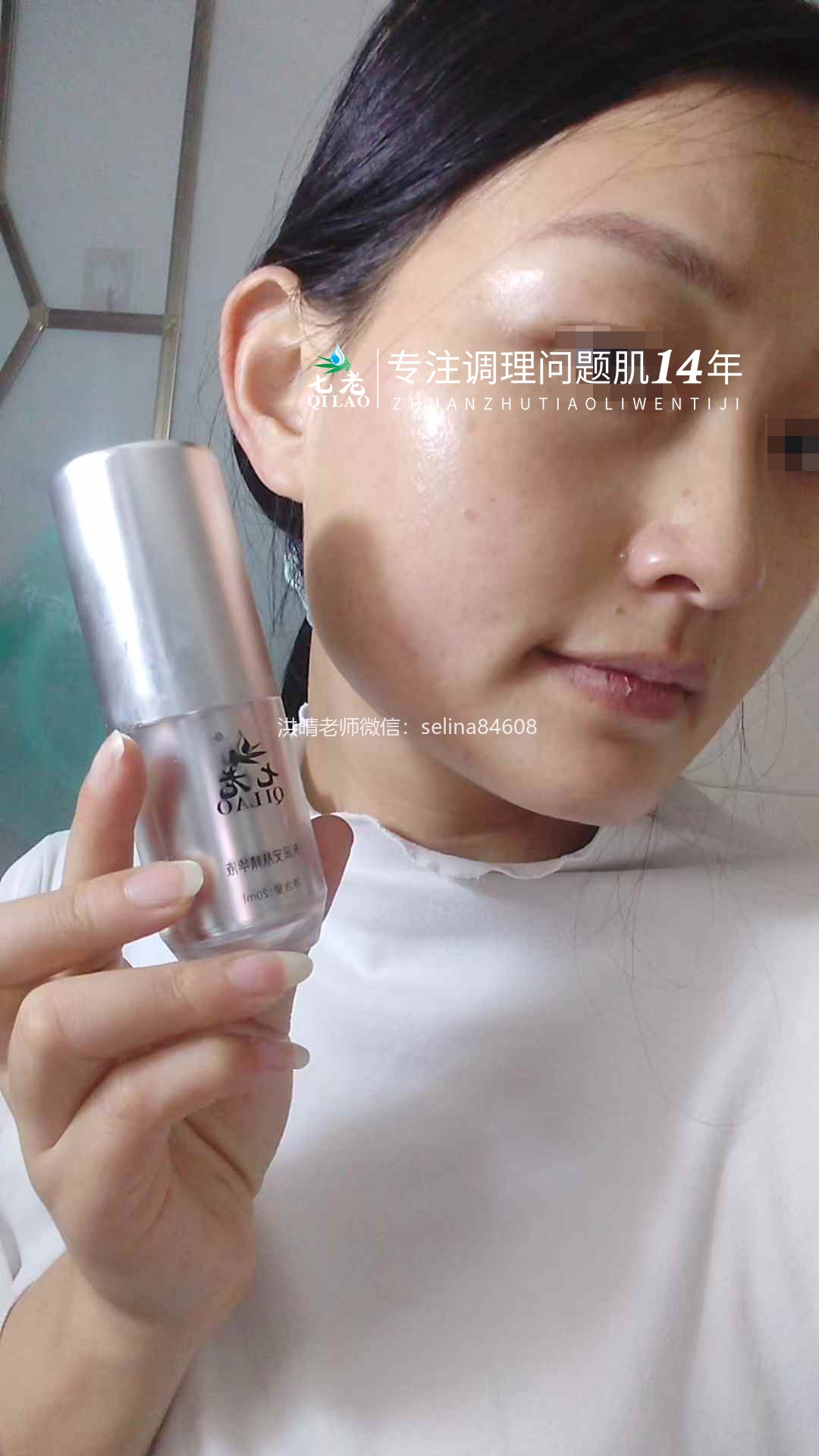 七老激素脸顽固痘痘修复案例