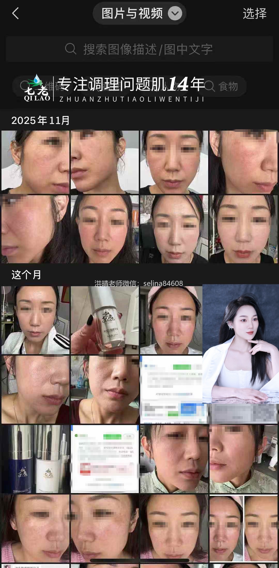 七老激素脸修复案例