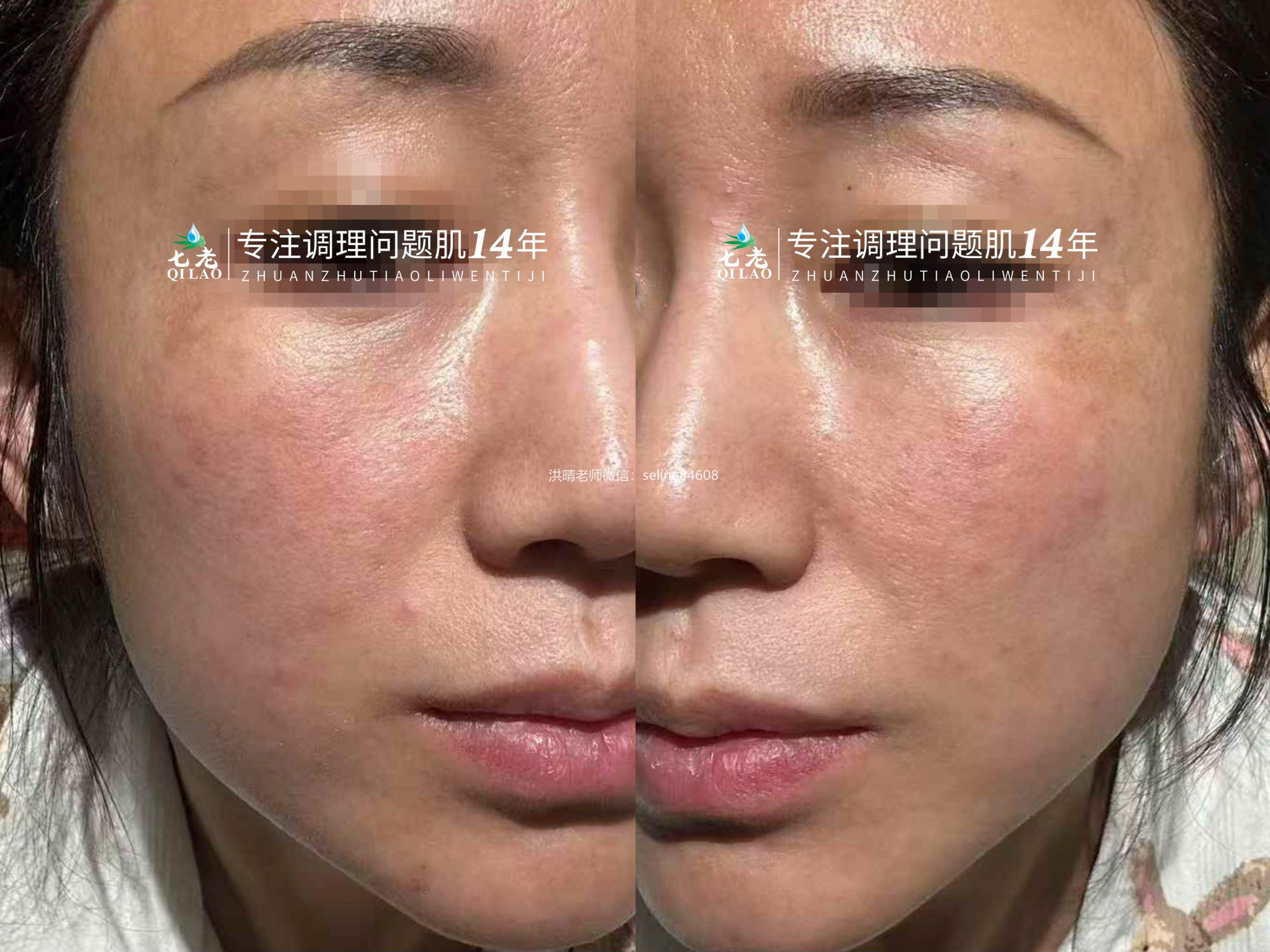 七老激素脸修复案例