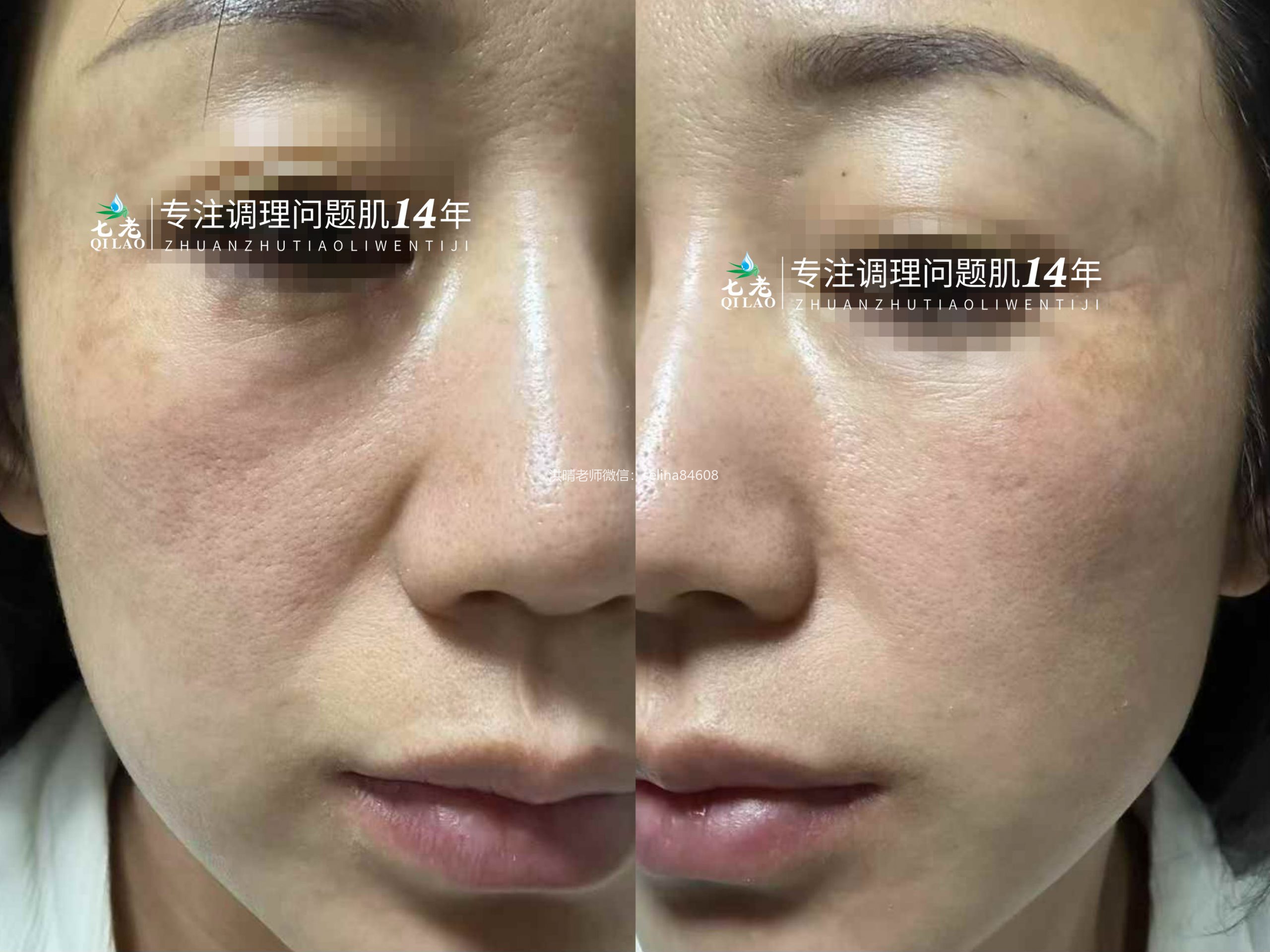 七老激素脸修复案例