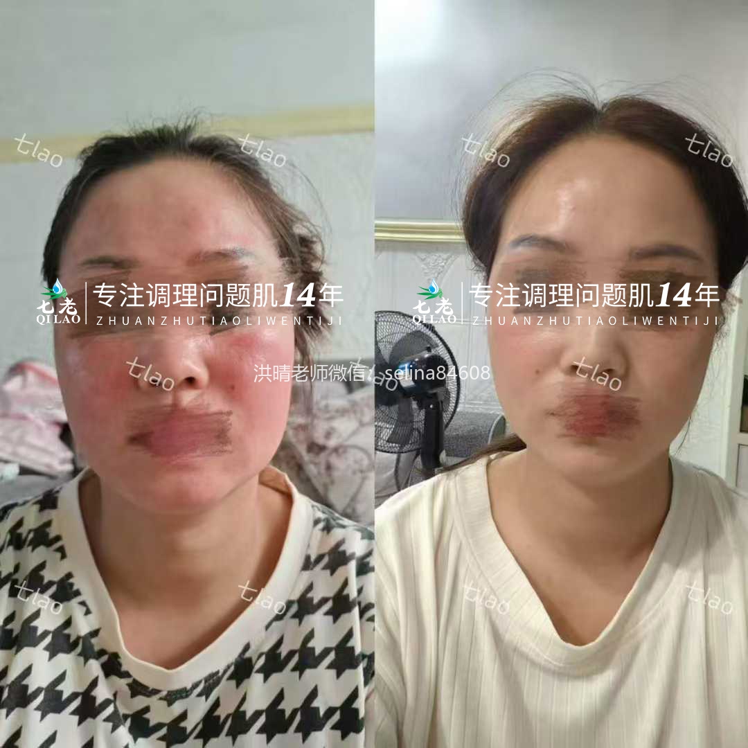 七老红烫肌修护案例