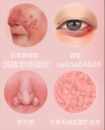 七老关于玫瑰痤疮给大家科普一下