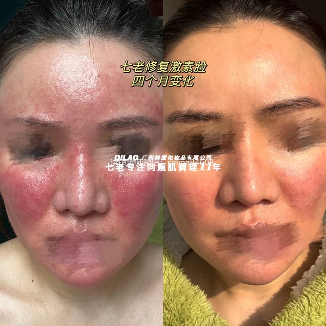 七老关于玫瑰痤疮给大家科普一下