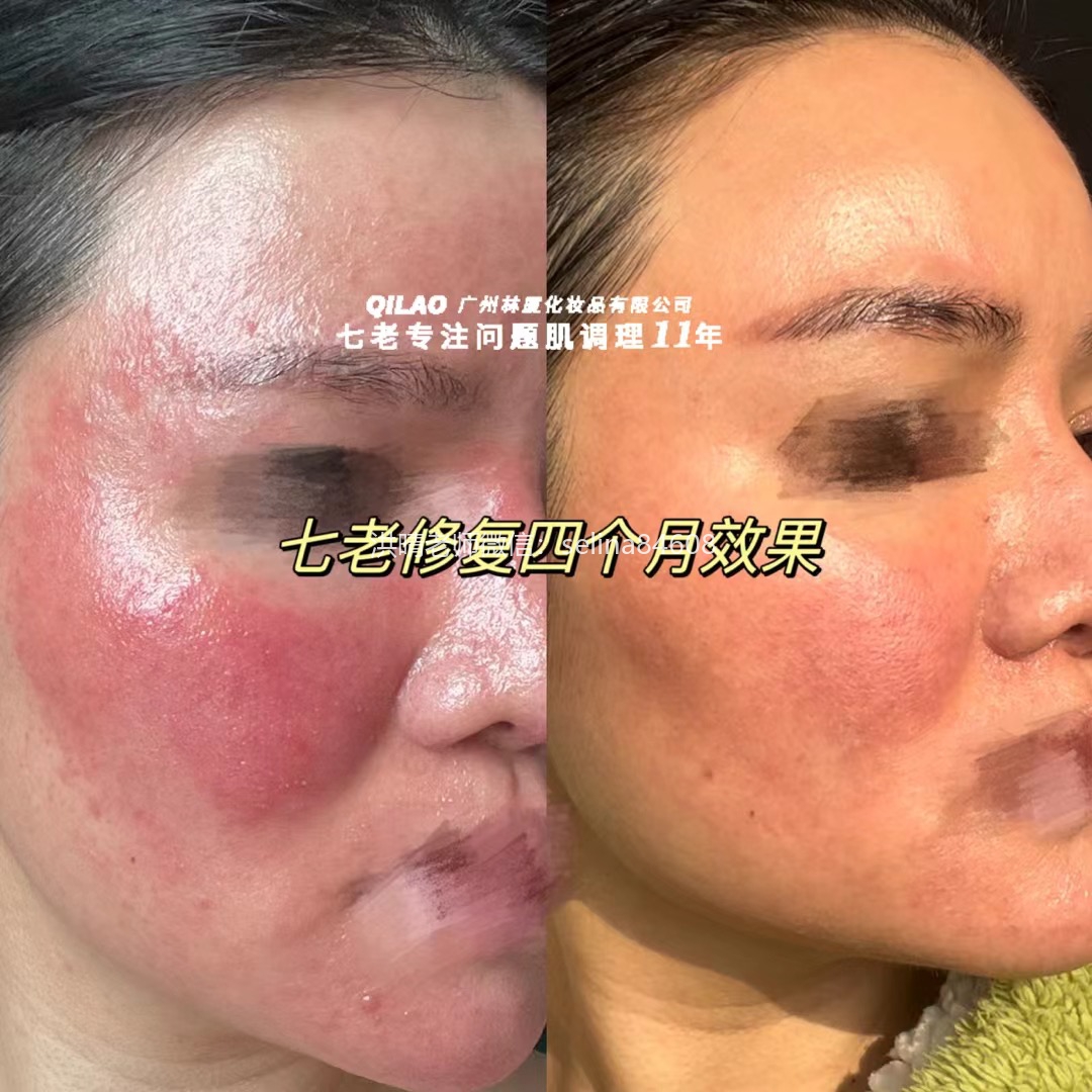 七老关于玫瑰痤疮给大家科普一下