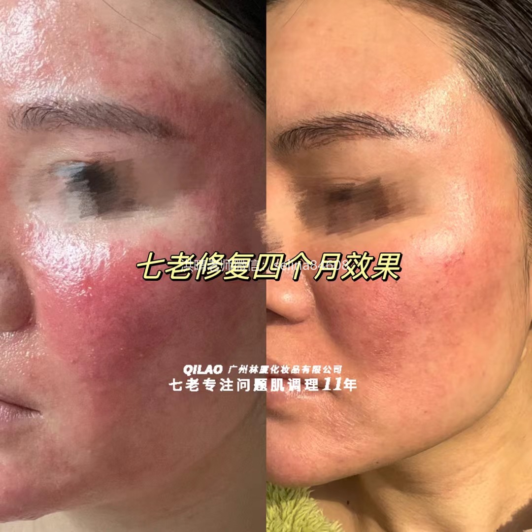 七老关于玫瑰痤疮给大家科普一下