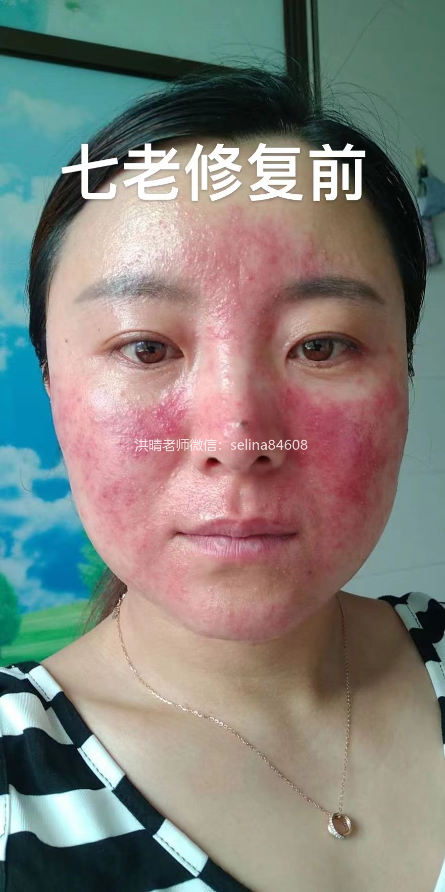 七老关于玫瑰痤疮给大家科普一下