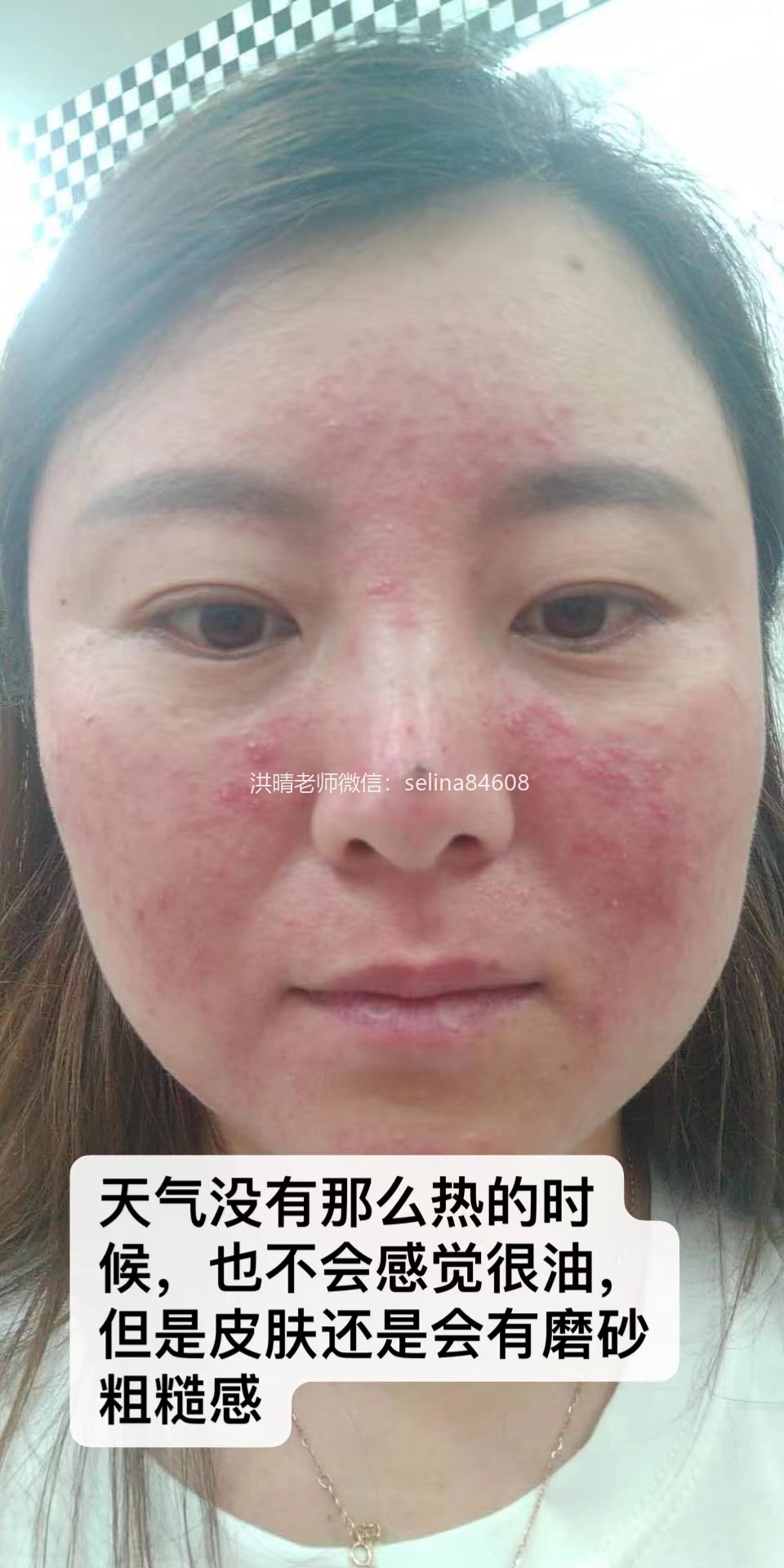 七老关于玫瑰痤疮给大家科普一下