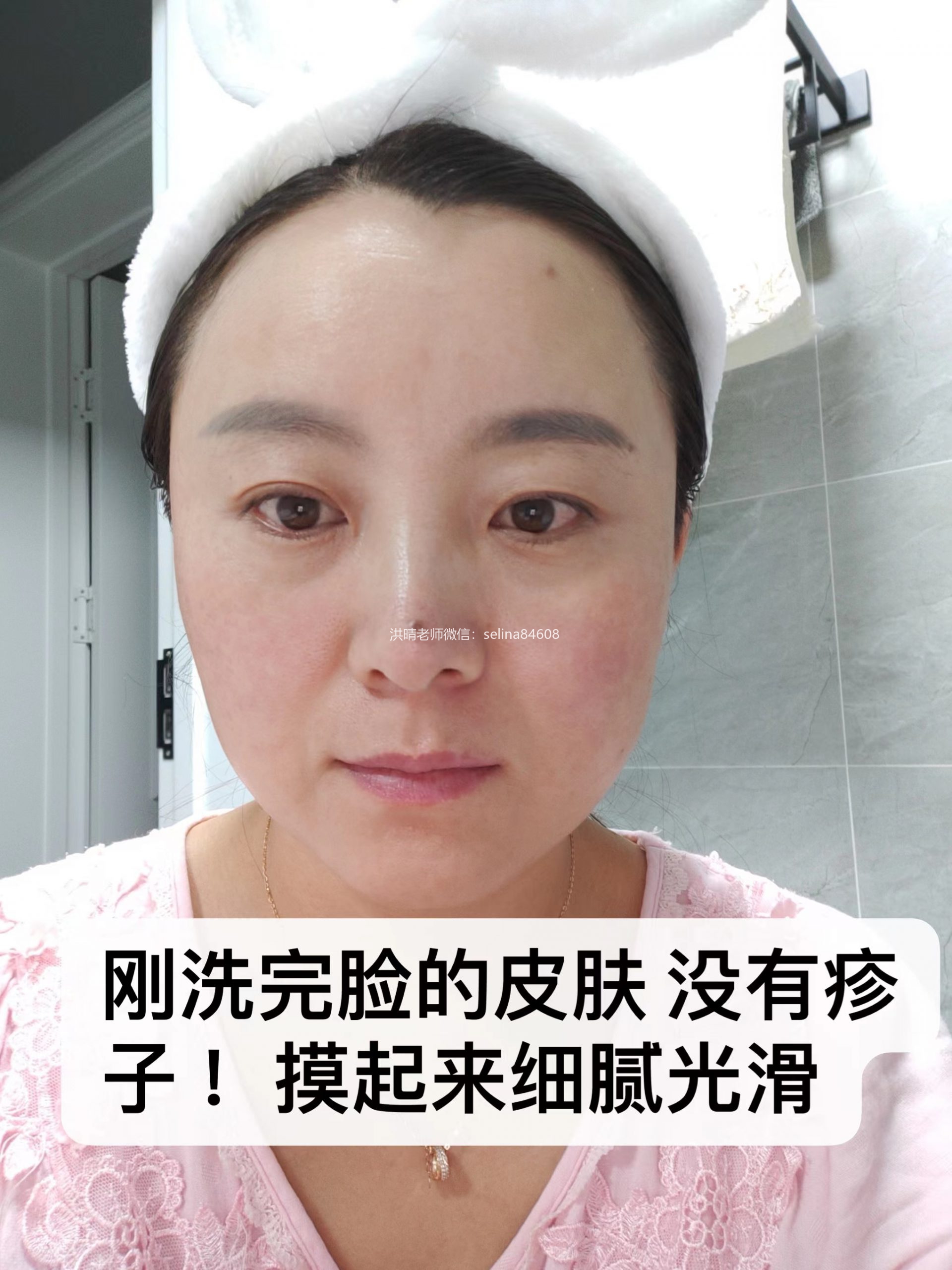 七老关于玫瑰痤疮给大家科普一下