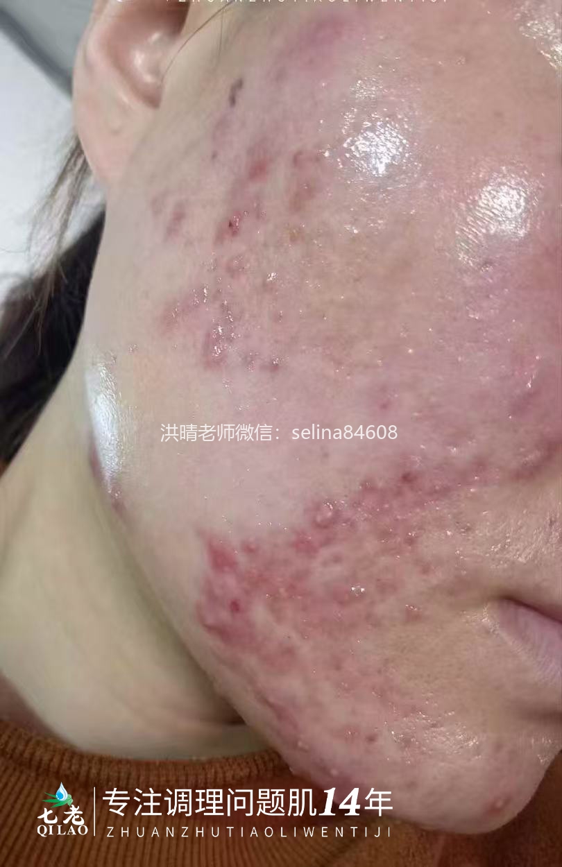 七老激素脸激素痘修护案例