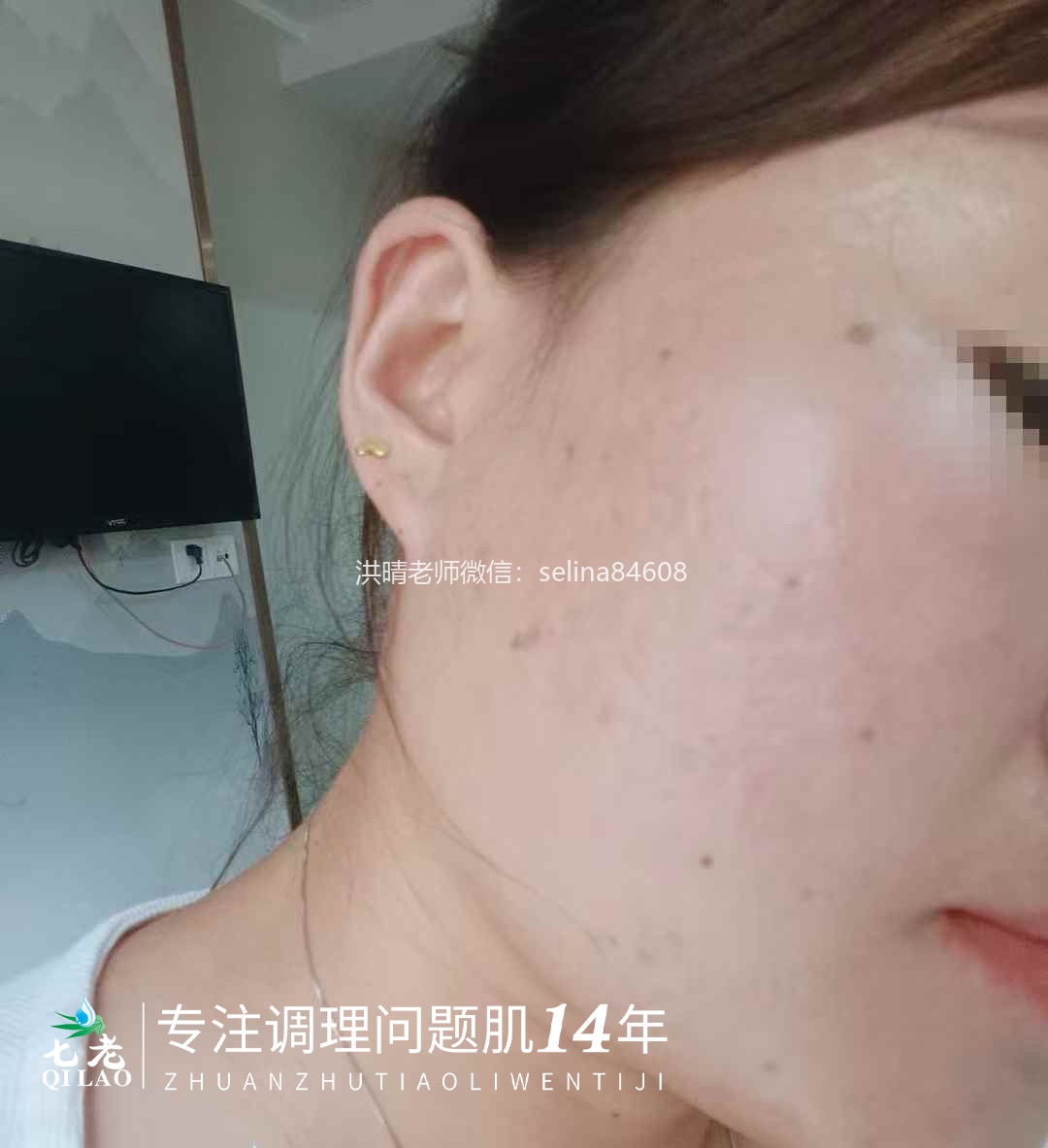 七老激素脸激素痘修护案例