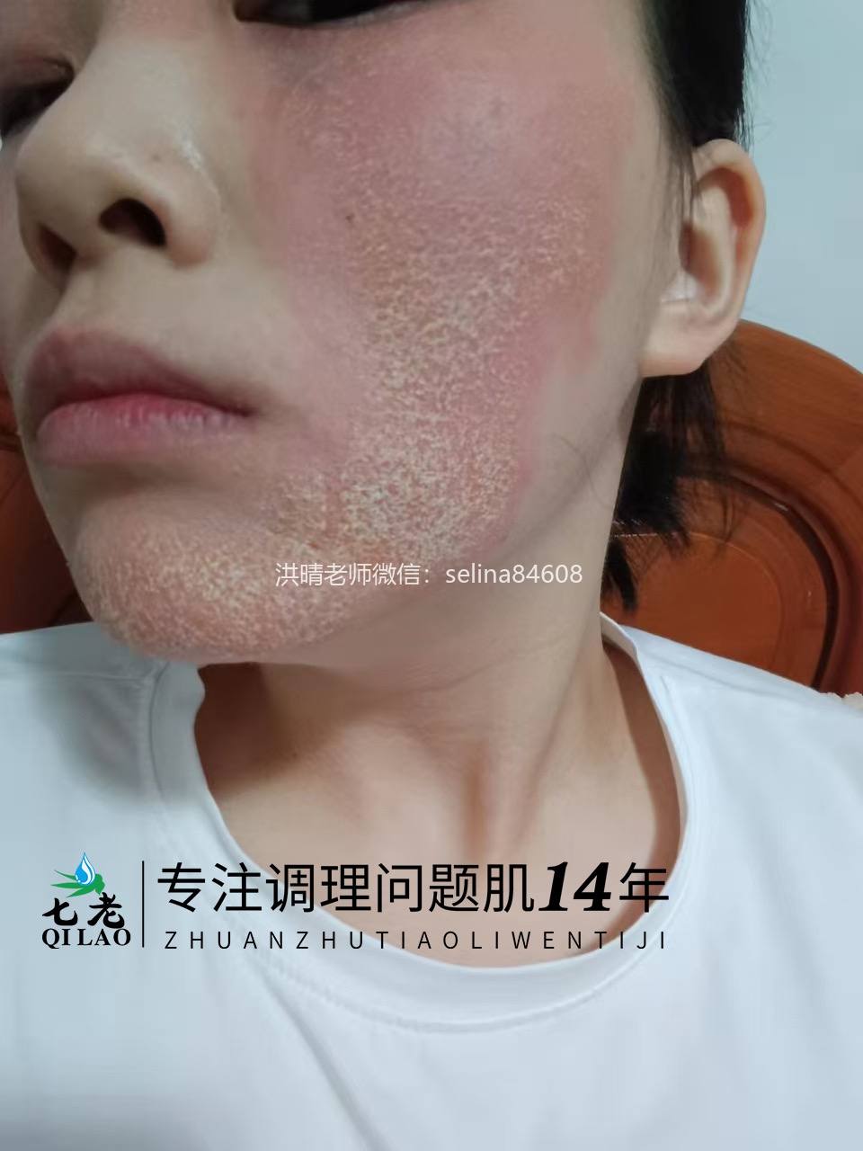 七老激素脸修护案例