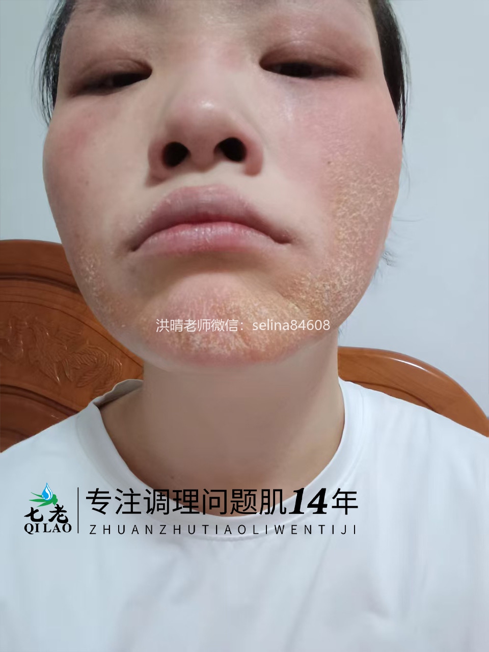 七老激素脸修护案例