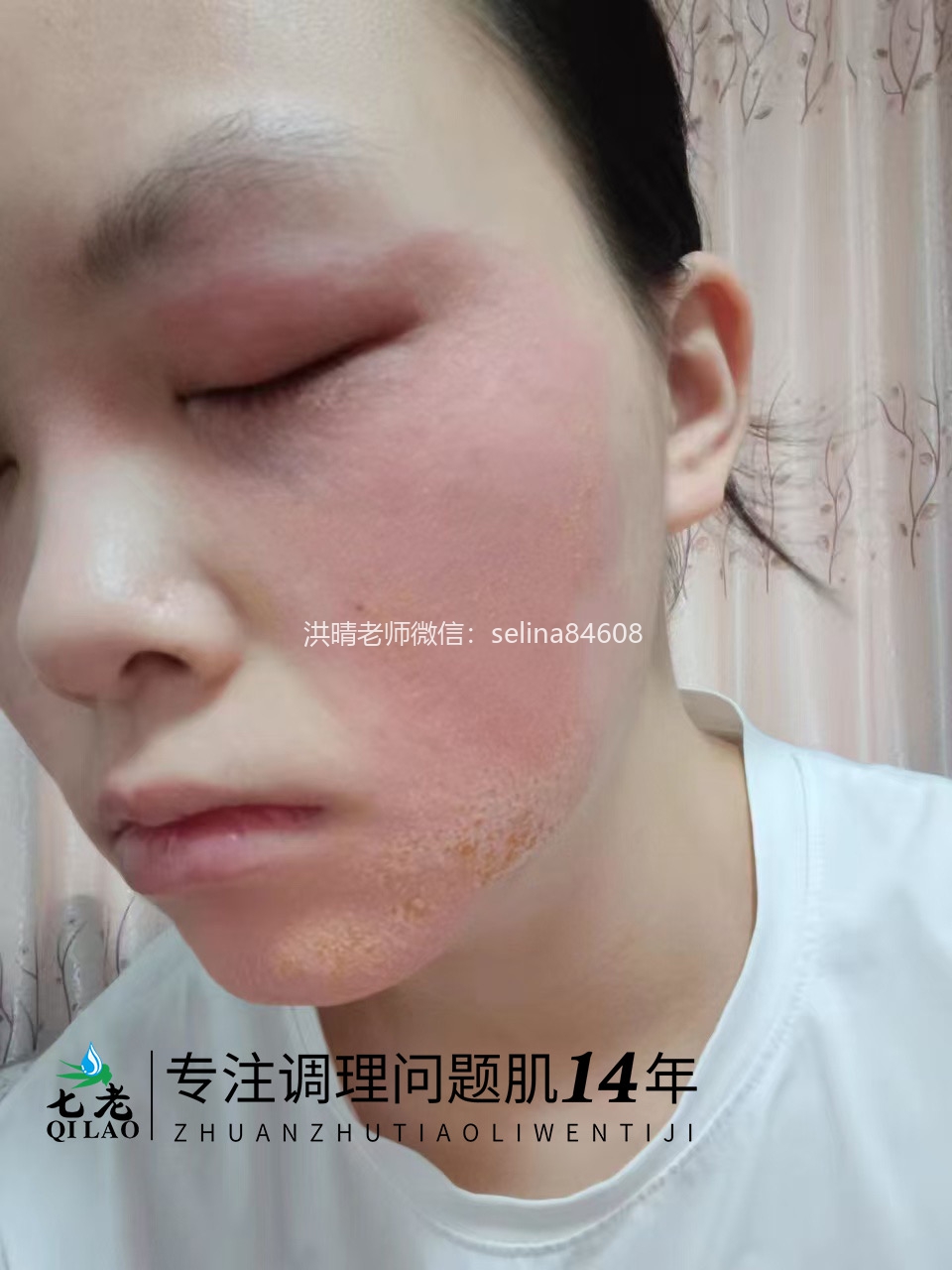 七老激素脸修护案例