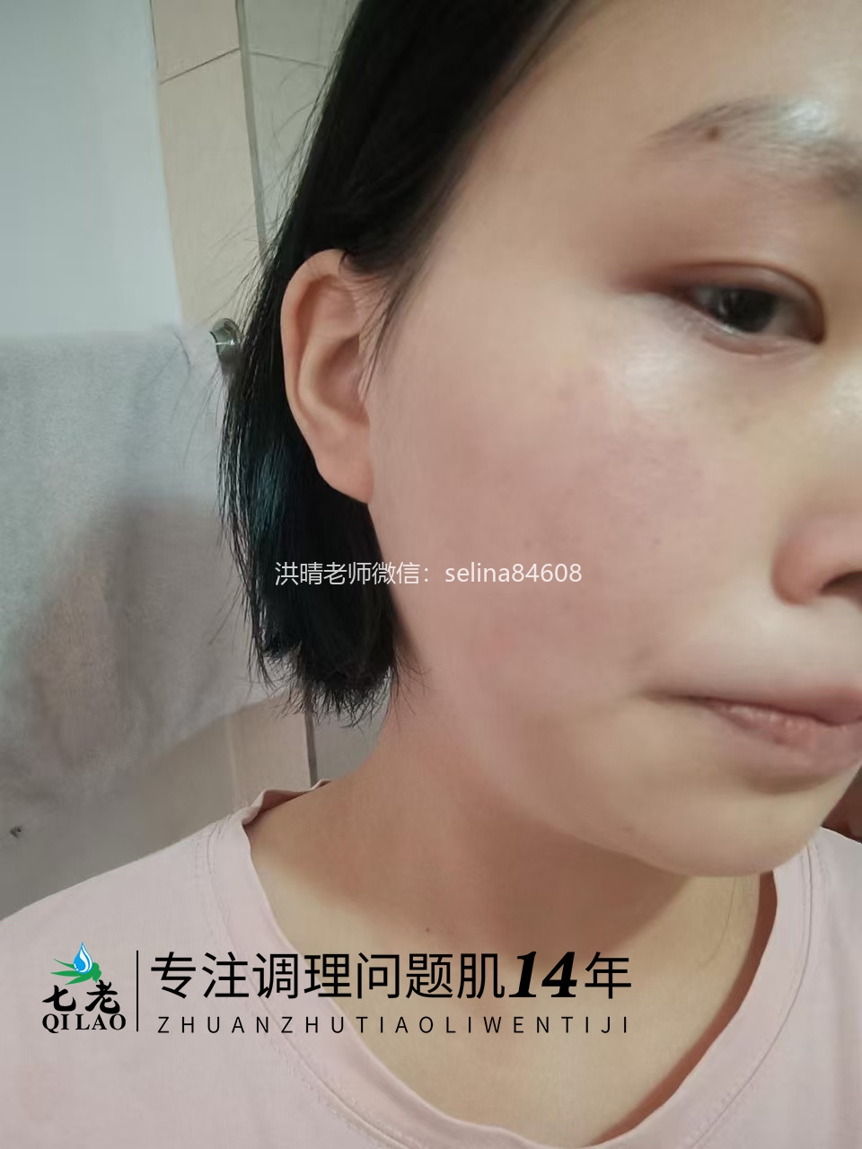 七老激素脸修护案例