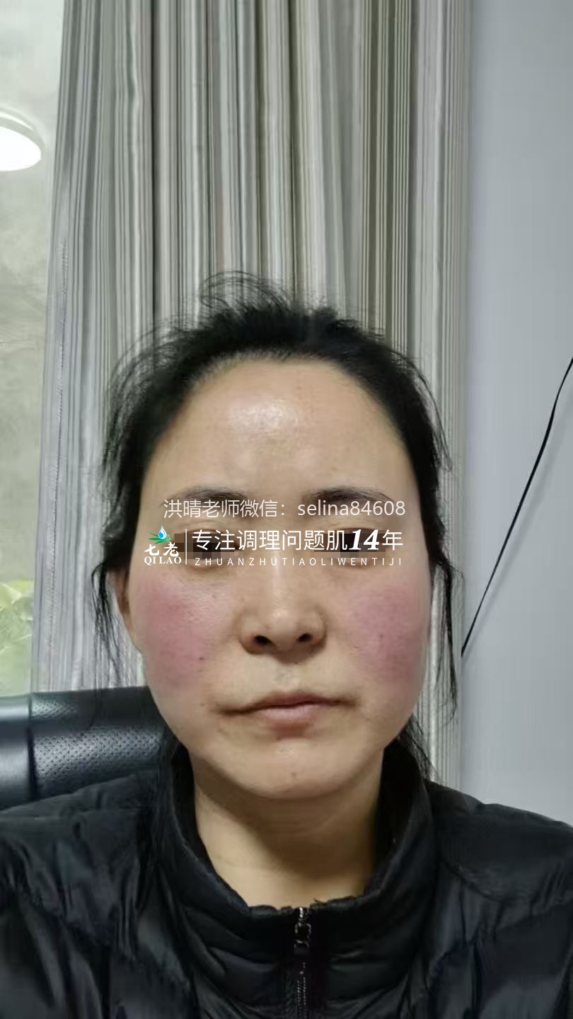 七老红烫肌修护案例