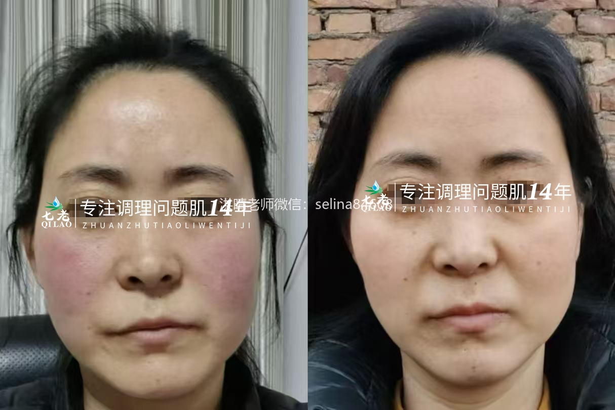 七老红烫肌修护案例