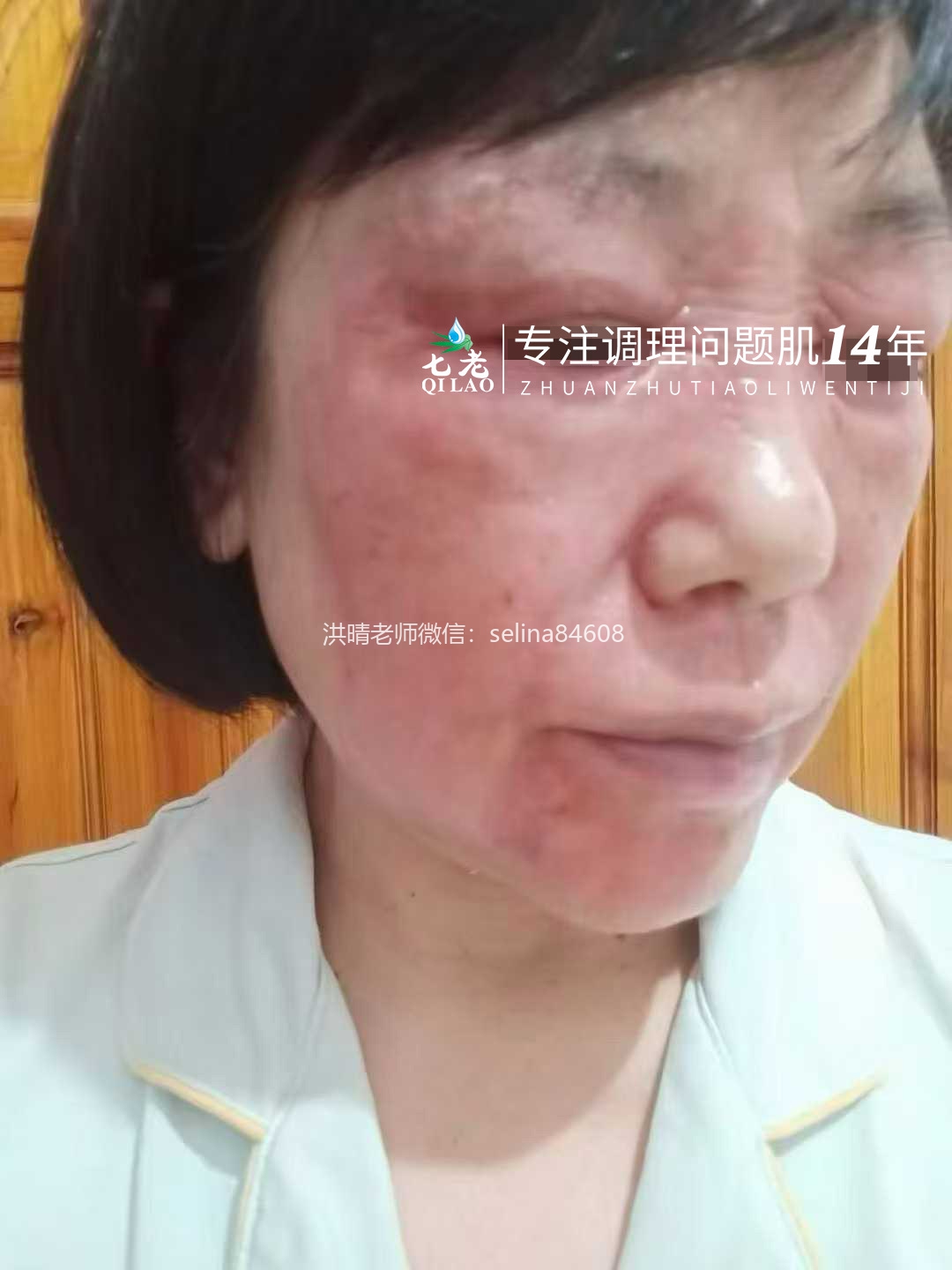 七老玫瑰皮修护案例