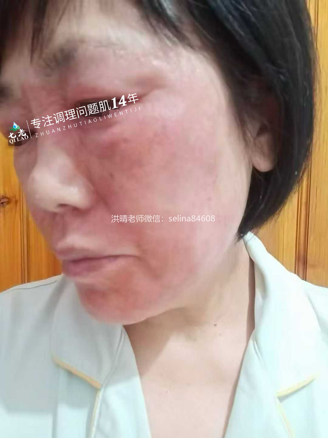 七老玫瑰皮修护案例