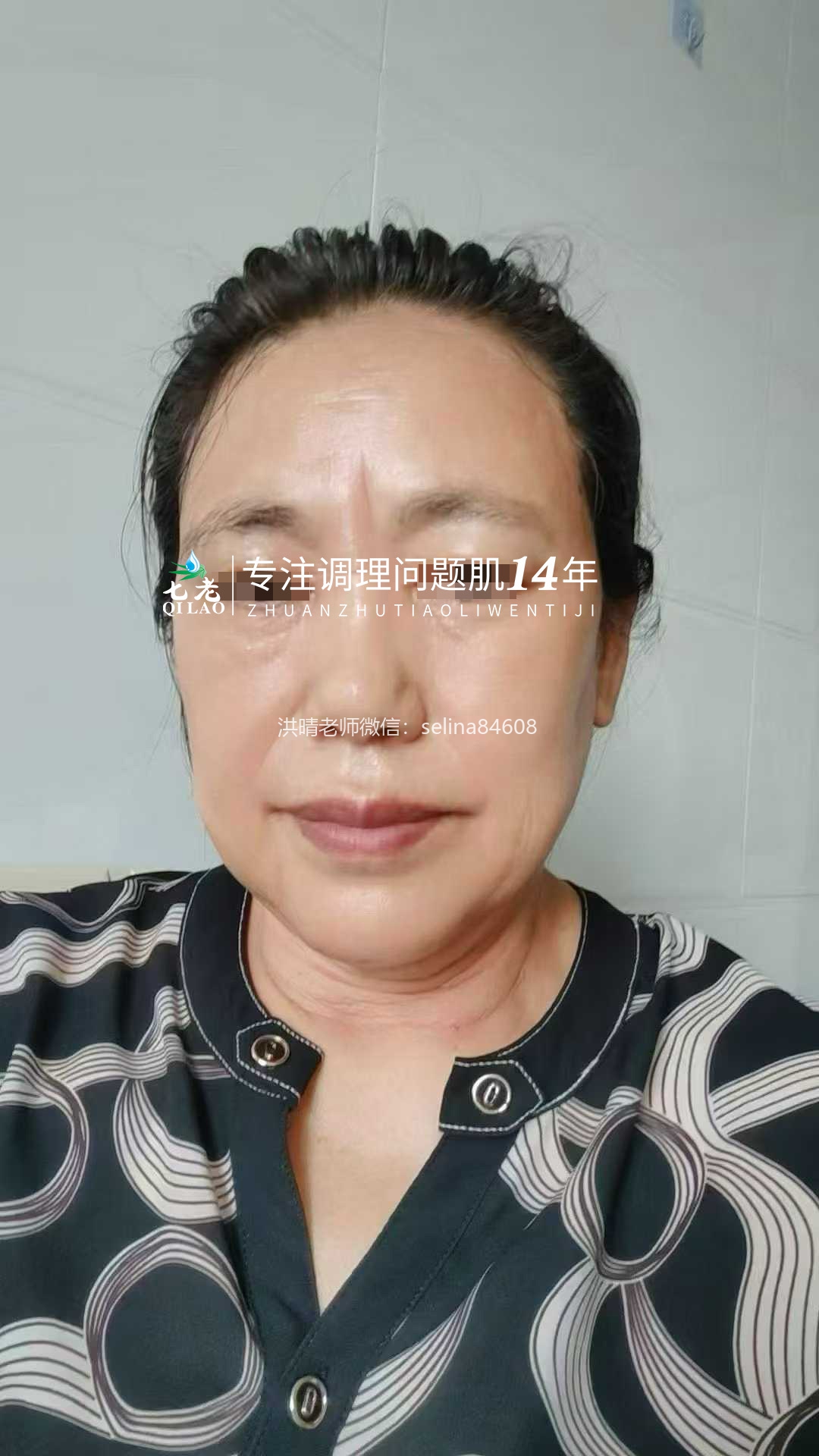 七老玫瑰皮修护案例