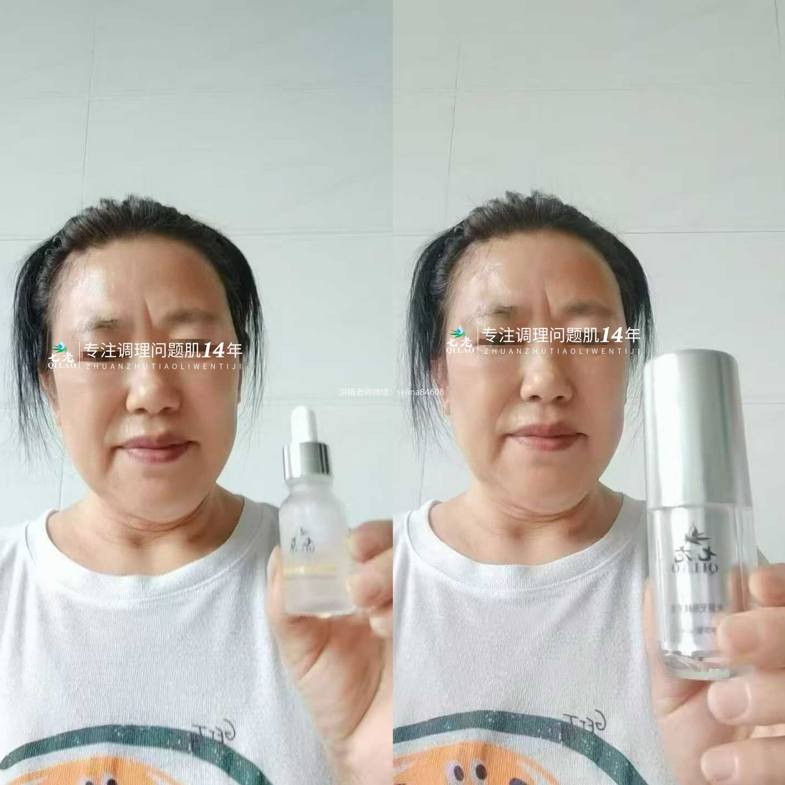 七老玫瑰皮修护案例