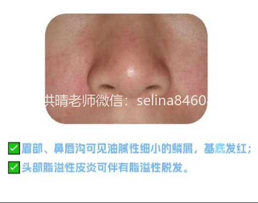 脂溢性皮炎的诱发因素以及带来的伤害