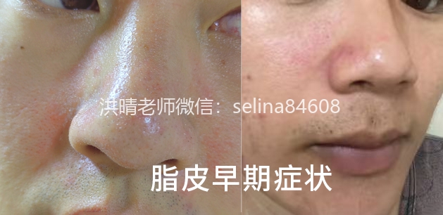 脂溢性皮炎的诱发因素以及带来的伤害