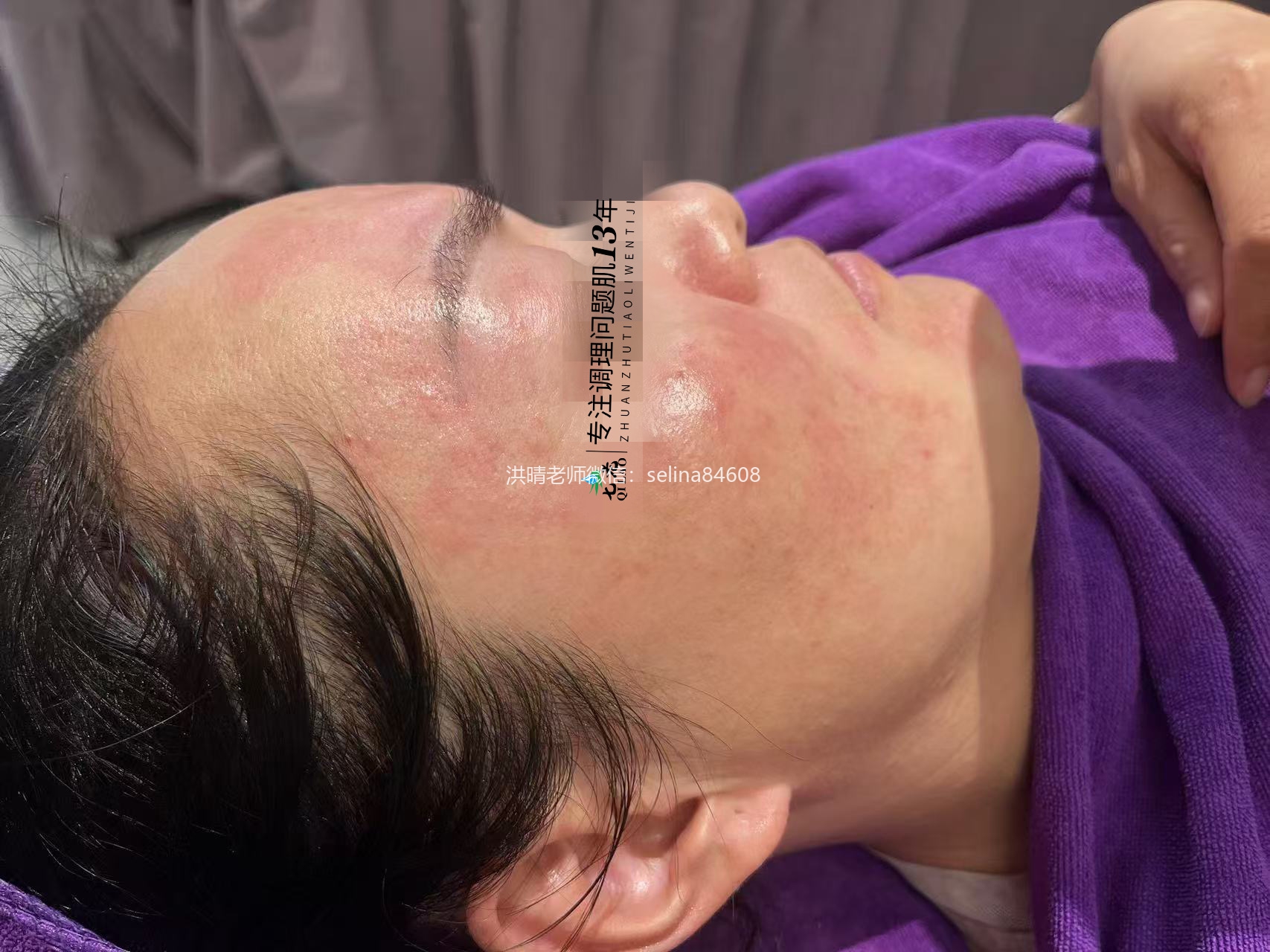 七老激素脸玫瑰痤疮修护案例