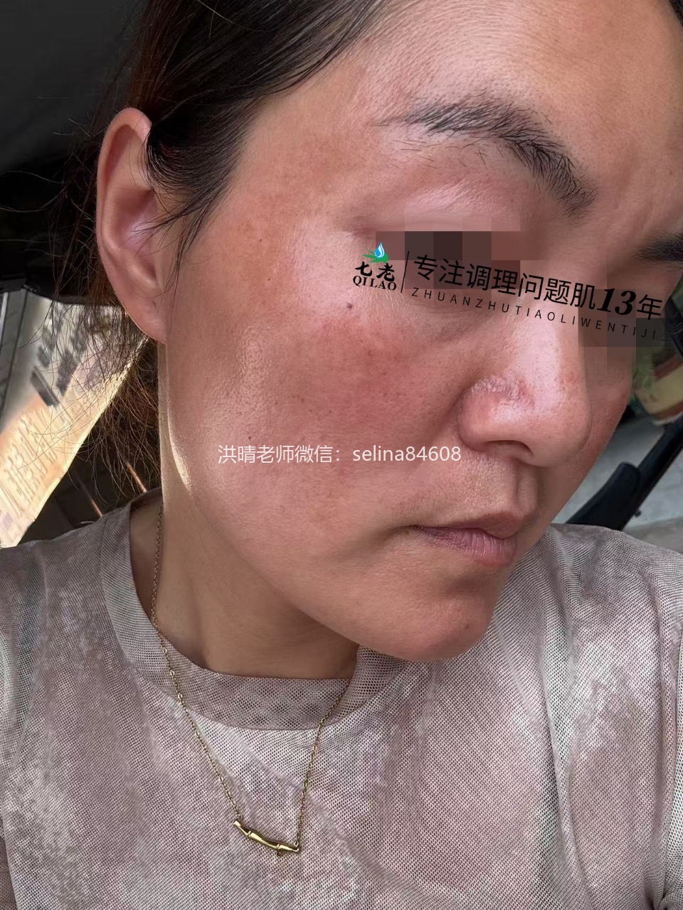 七老激素脸玫瑰痤疮修护案例
