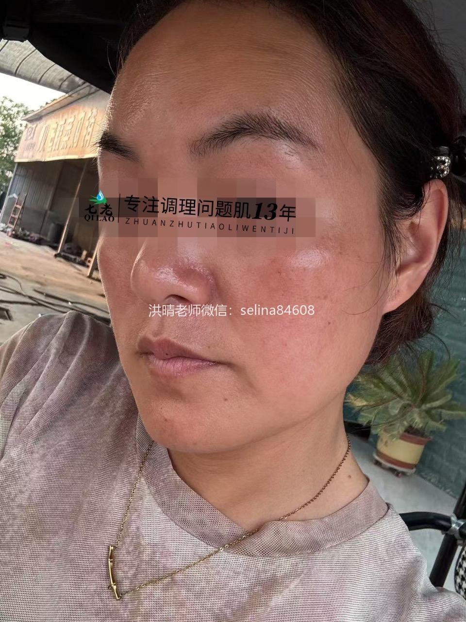 七老激素脸玫瑰痤疮修护案例