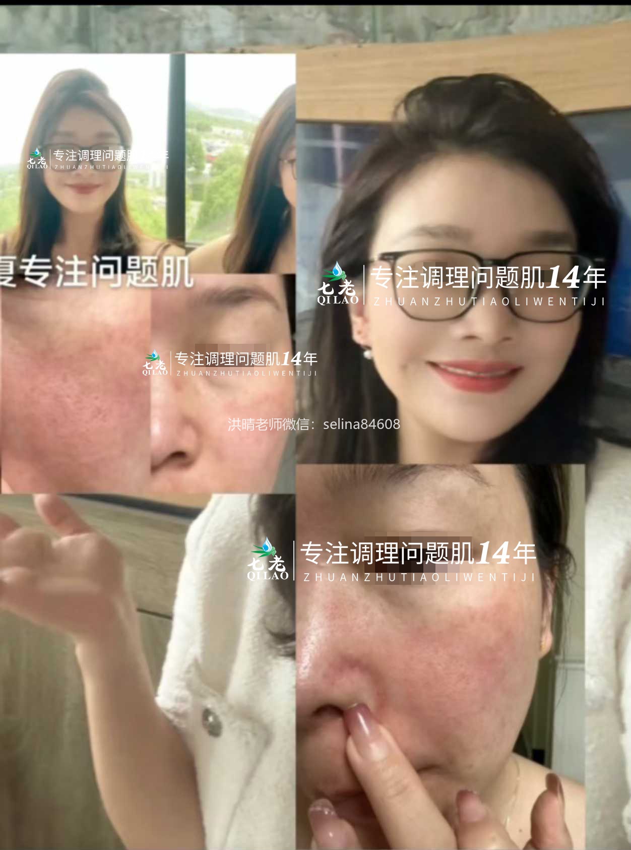 七老激素脸痘痘过敏脸修护案例