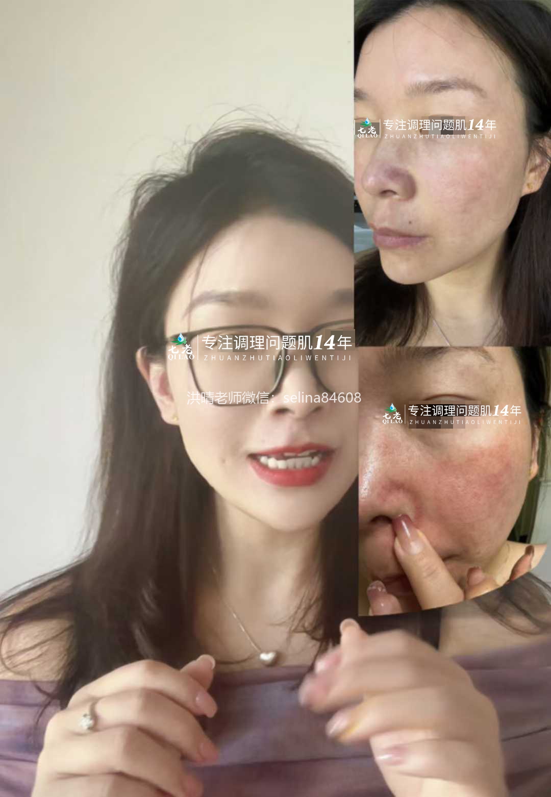 七老激素脸痘痘过敏脸修护案例