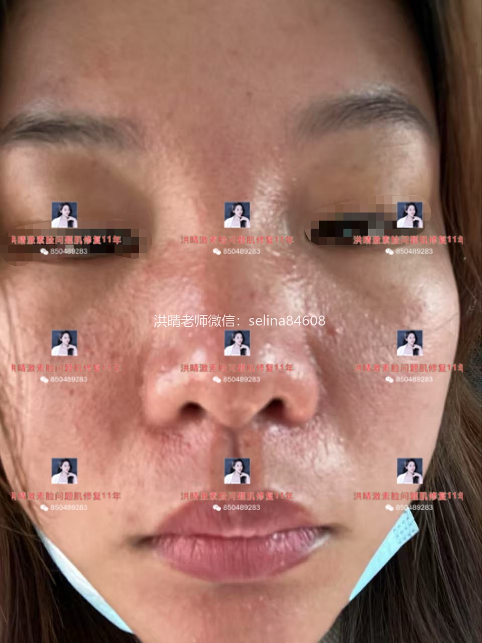 七老洪晴告诉你脂溢性皮炎和敏感的区别