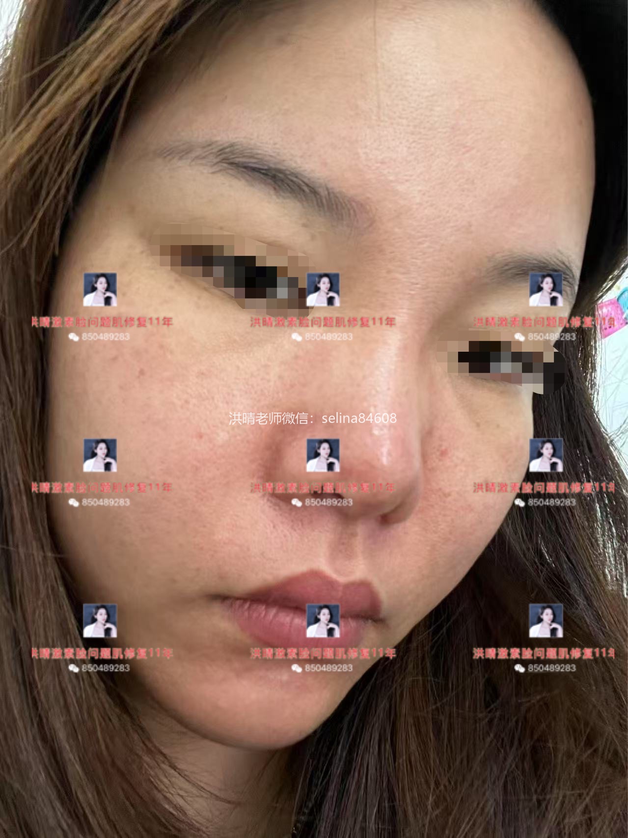 七老洪晴告诉你脂溢性皮炎和敏感的区别