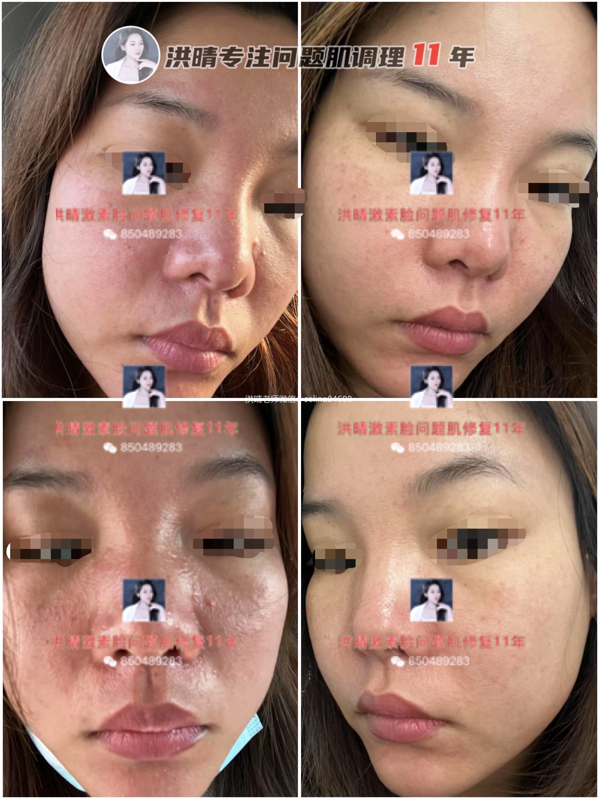 七老洪晴告诉你脂溢性皮炎和敏感的区别