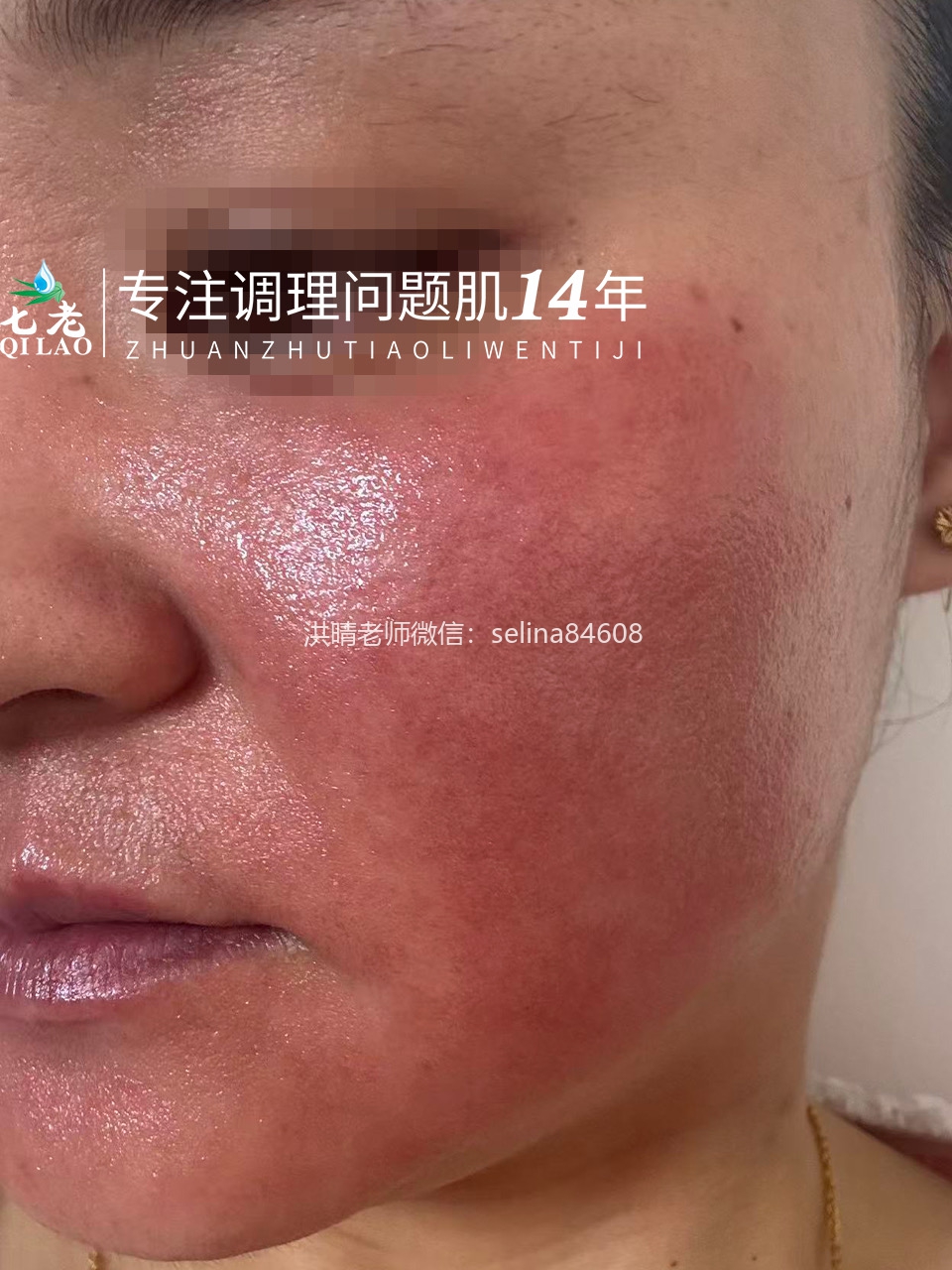 七老严重激素脸玫瑰皮炎修护案例