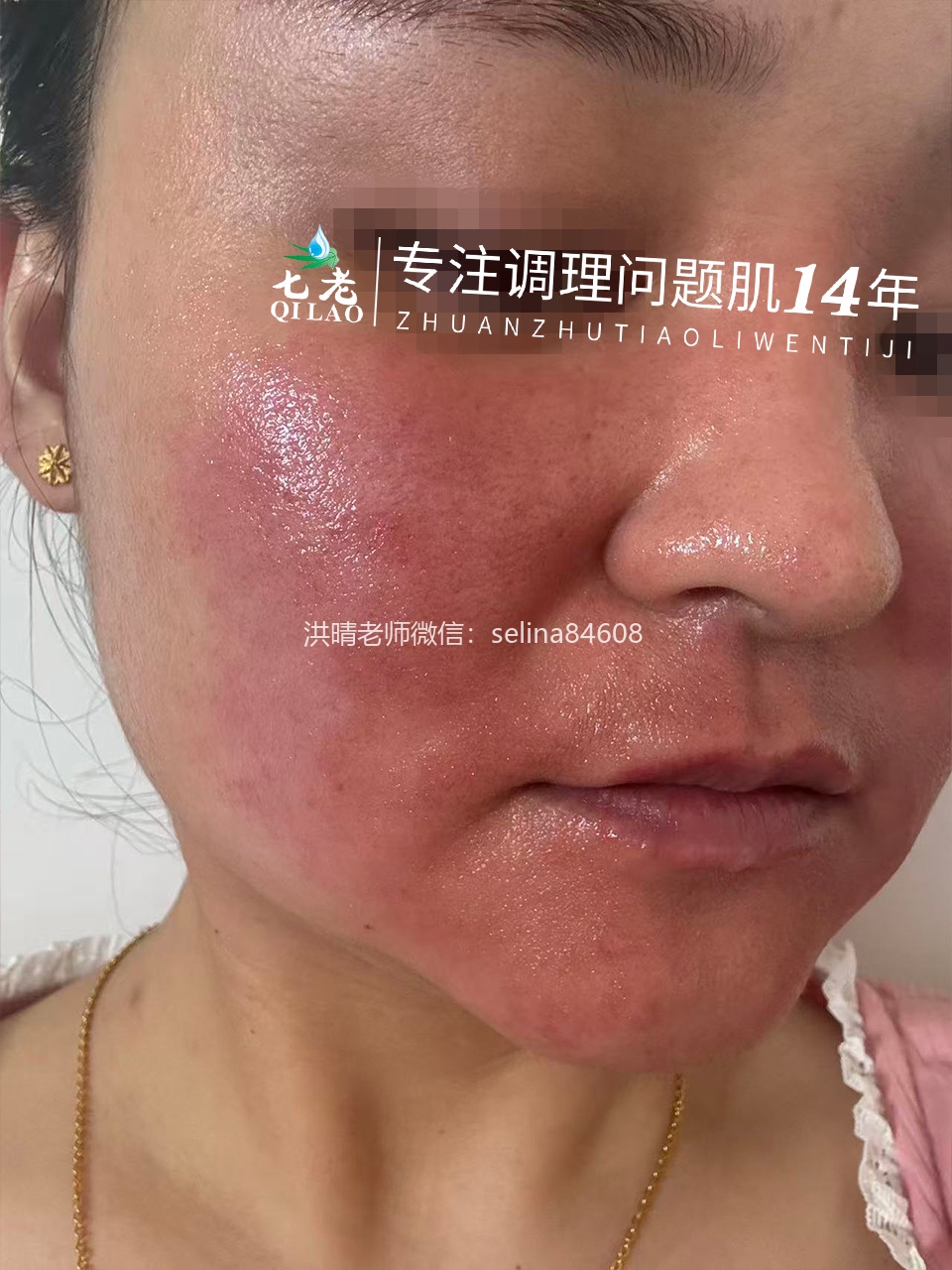 七老严重激素脸玫瑰皮炎修护案例