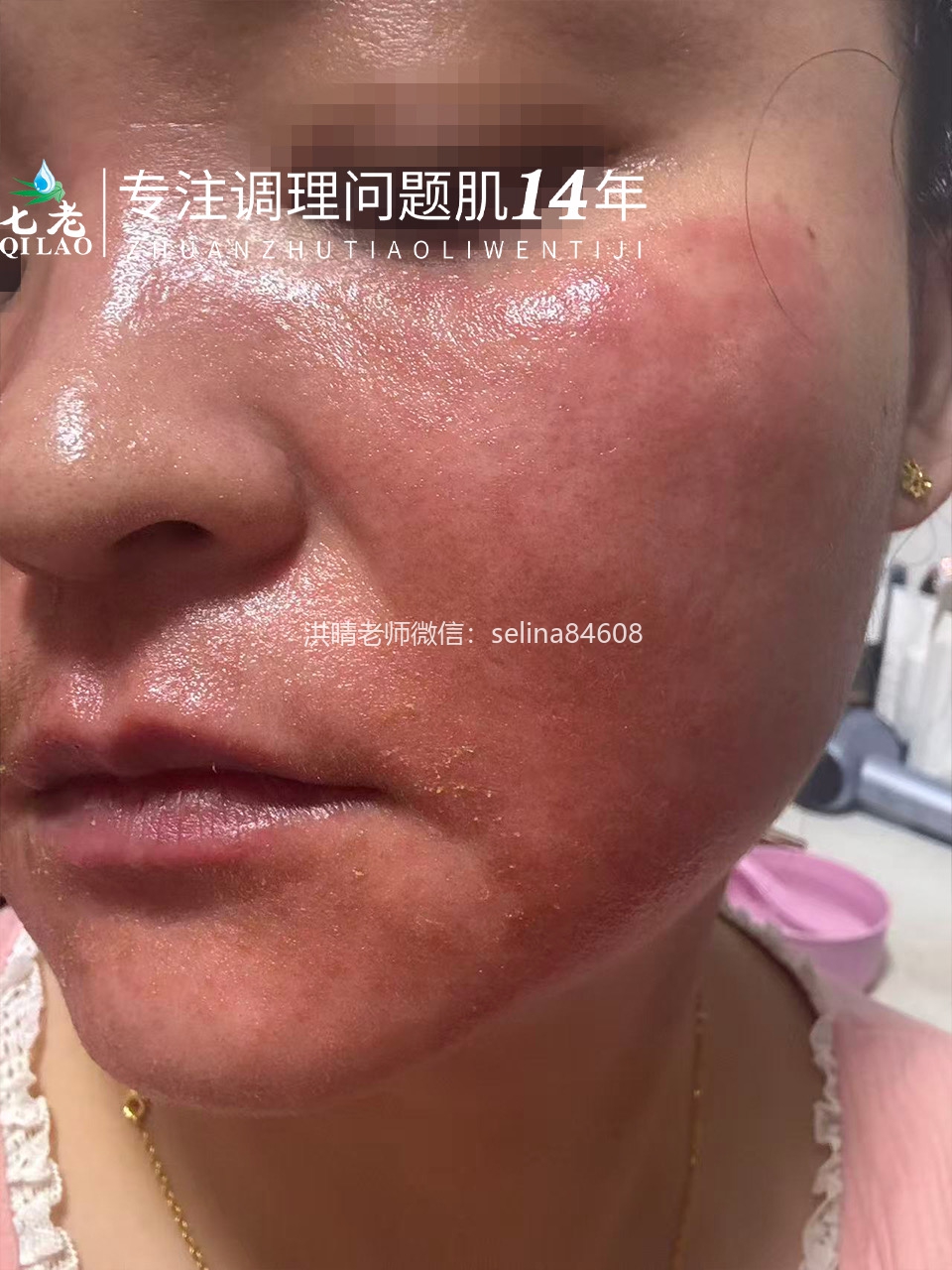 七老严重激素脸玫瑰皮炎修护案例