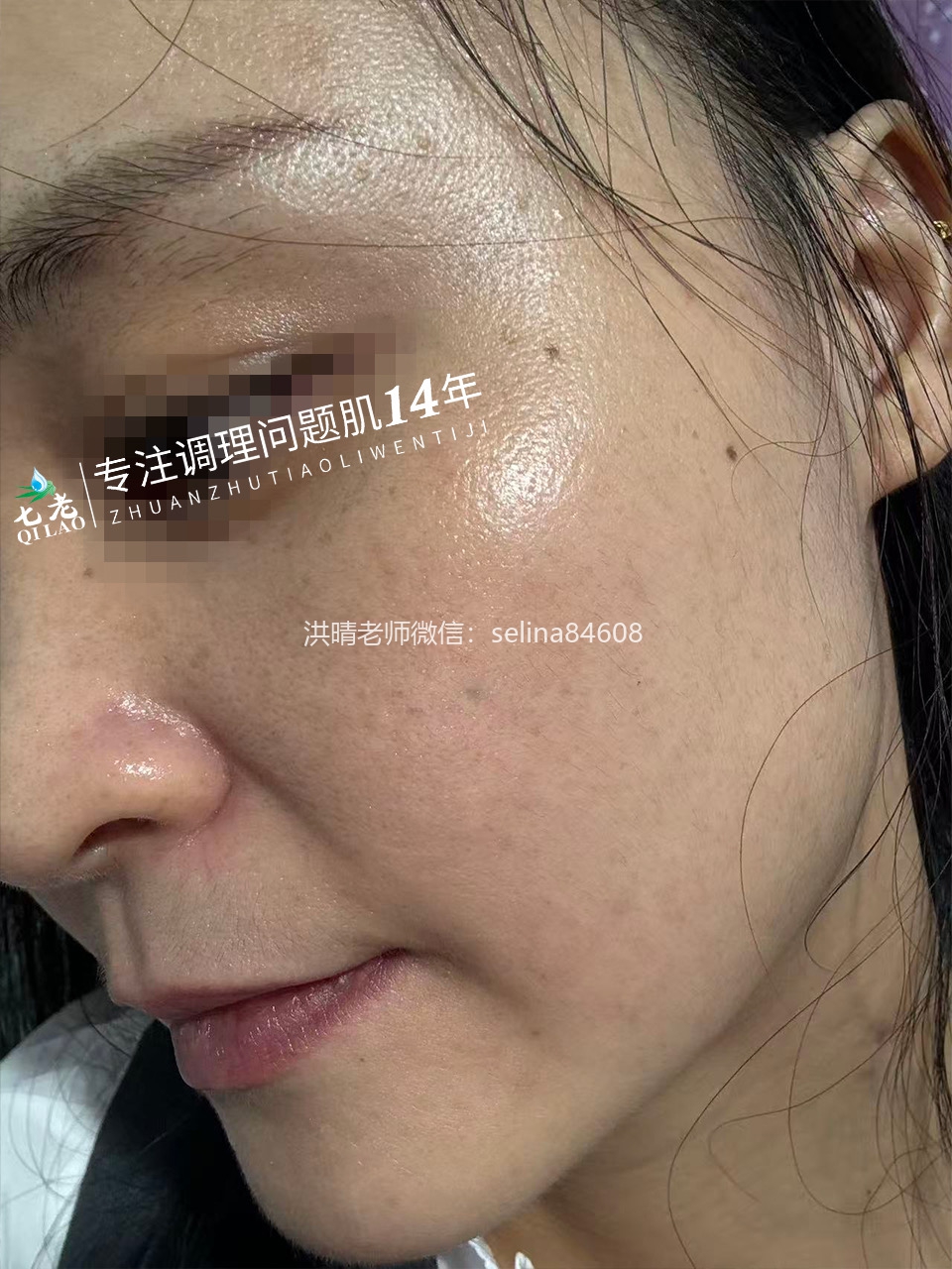 七老严重激素脸玫瑰皮炎修护案例