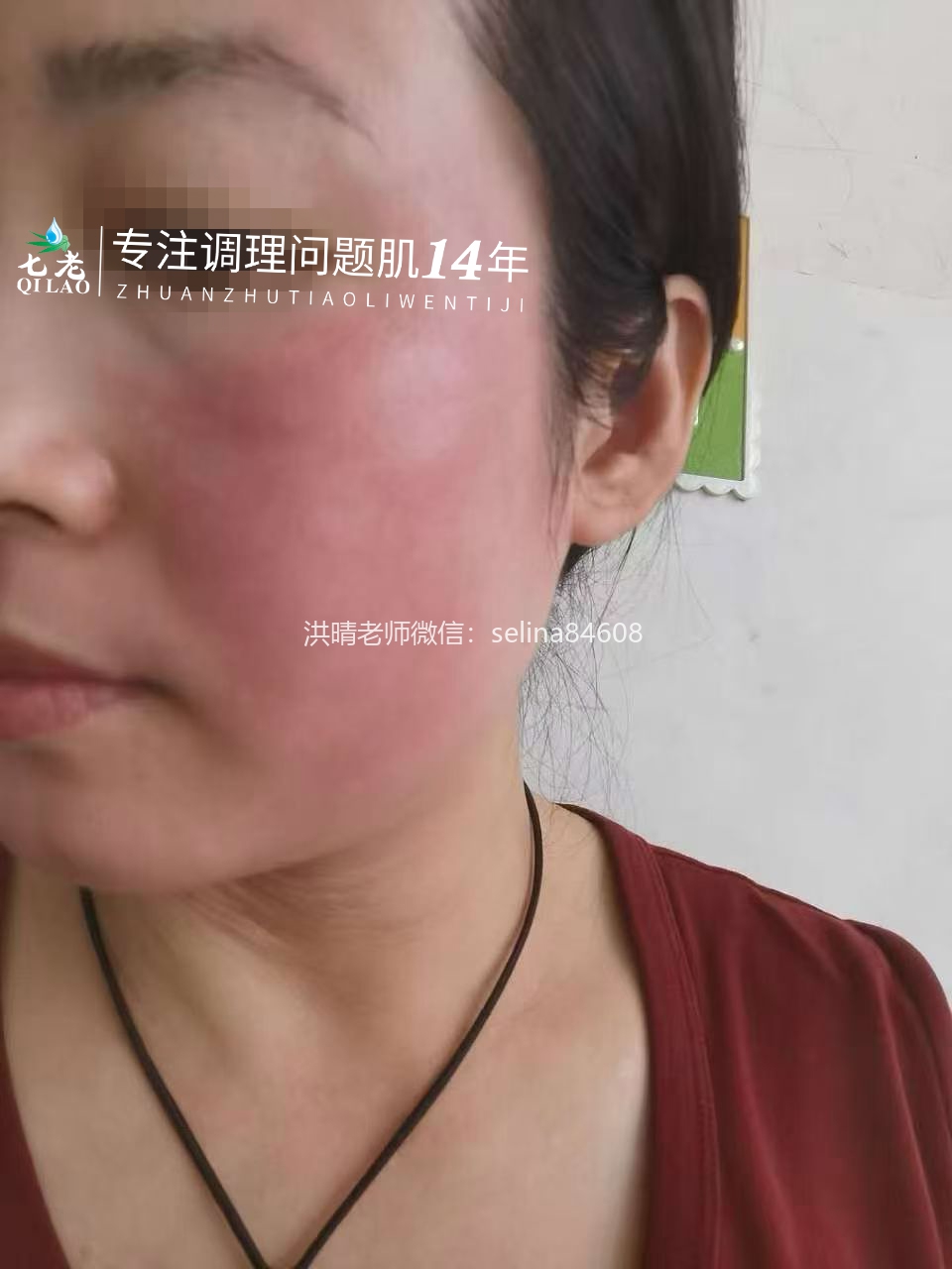 七老红烫肌大红脸修护案例