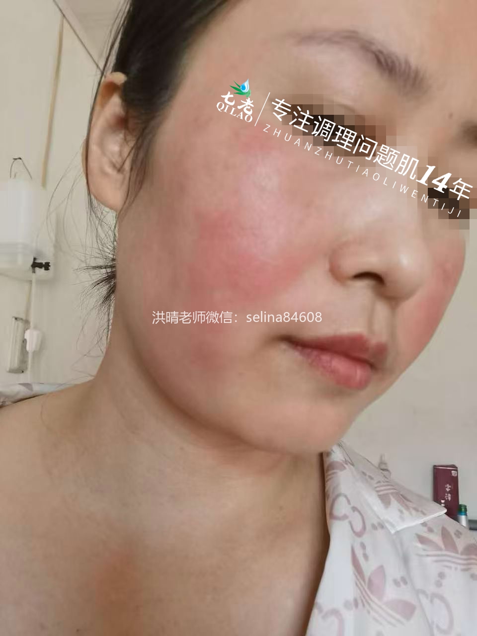 七老红烫肌大红脸修护案例