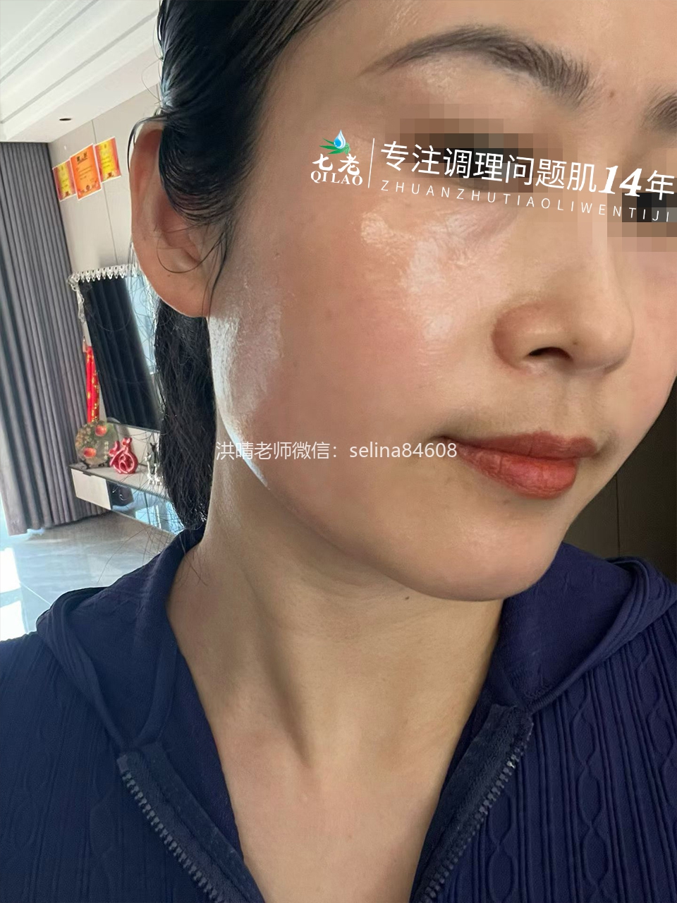 七老红烫肌大红脸修护案例