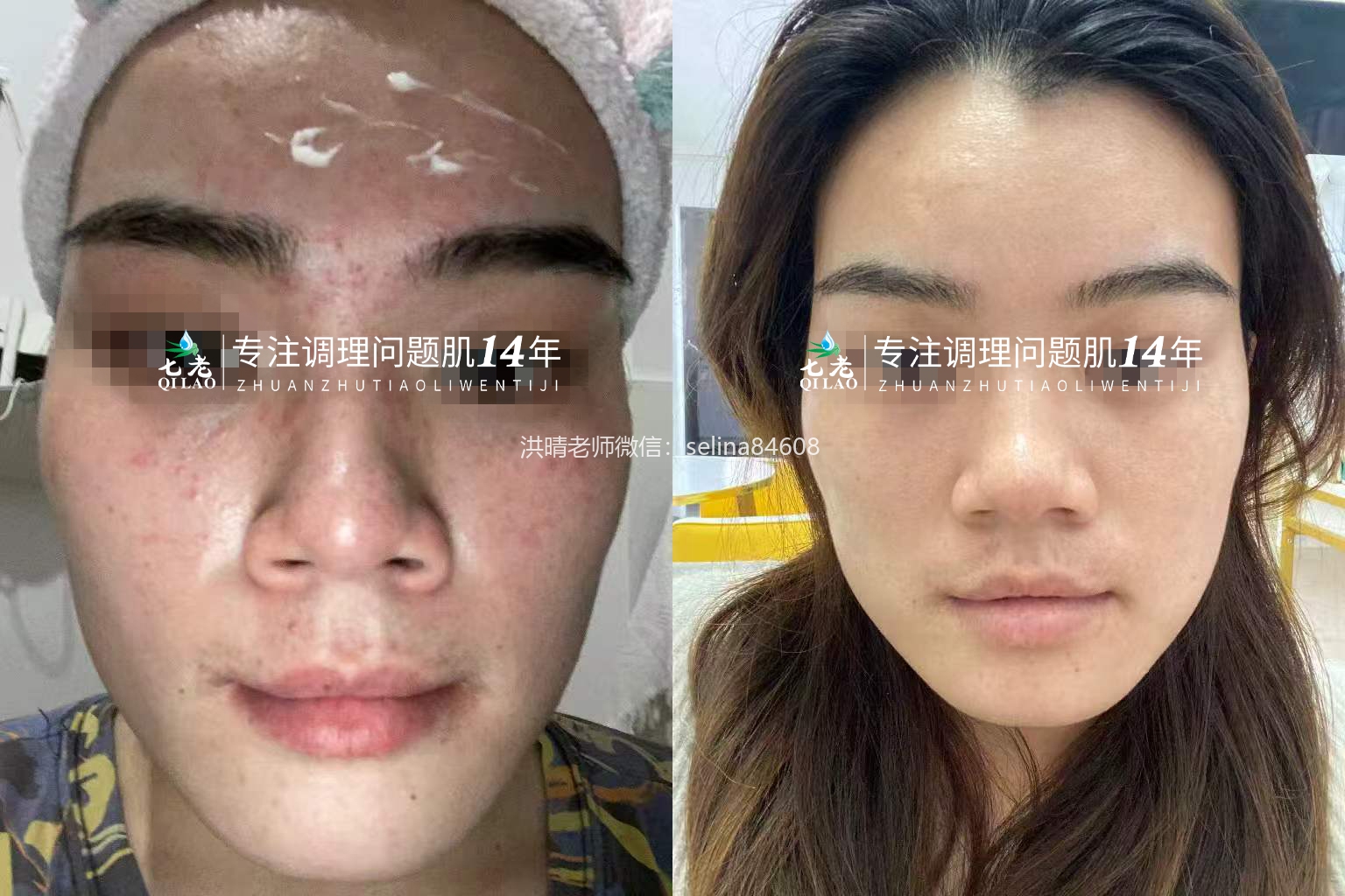 七老屏障受损痘痘疹子修护案例