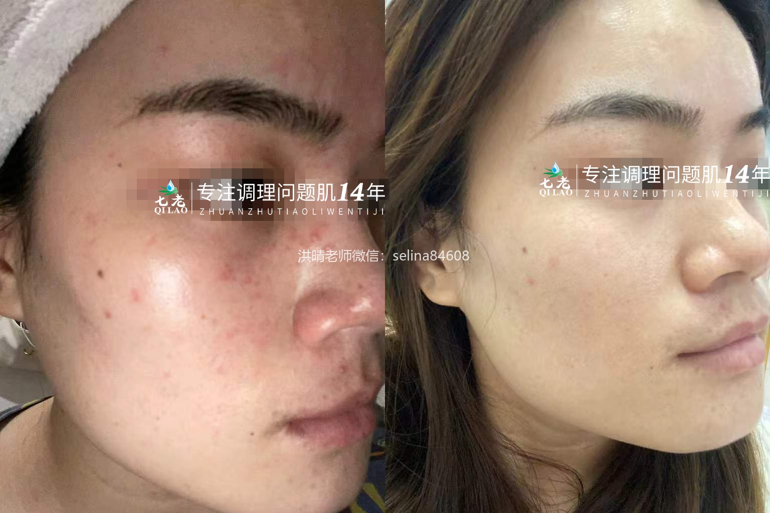 七老屏障受损痘痘疹子修护案例