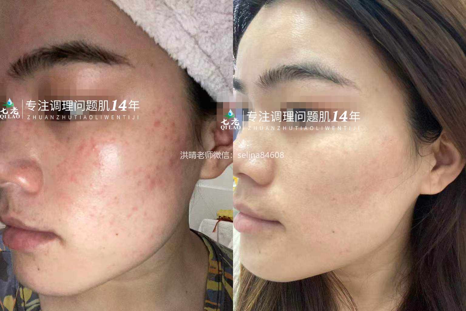 七老屏障受损痘痘疹子修护案例