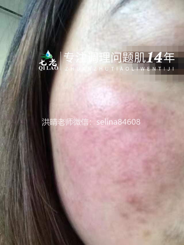 七老玫瑰皮红烫疹子修护案例