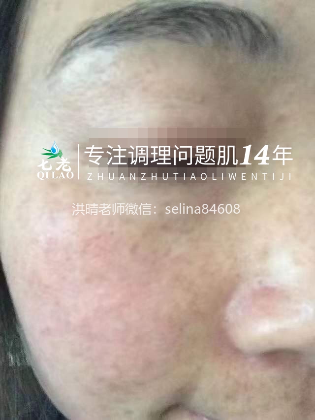 七老玫瑰皮红烫疹子修护案例