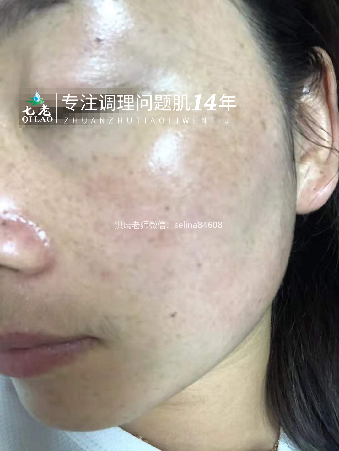 七老玫瑰皮红烫疹子修护案例